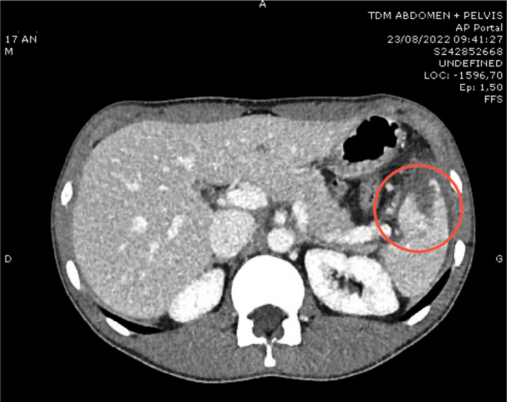 Coupe de scanner abdomen et pelvis avec une zone entourée en rouge dans la région splénique (corrigé)