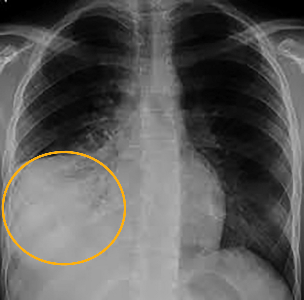 Radiographie thoracique de face avec une zone entourée en orange (corrigé)