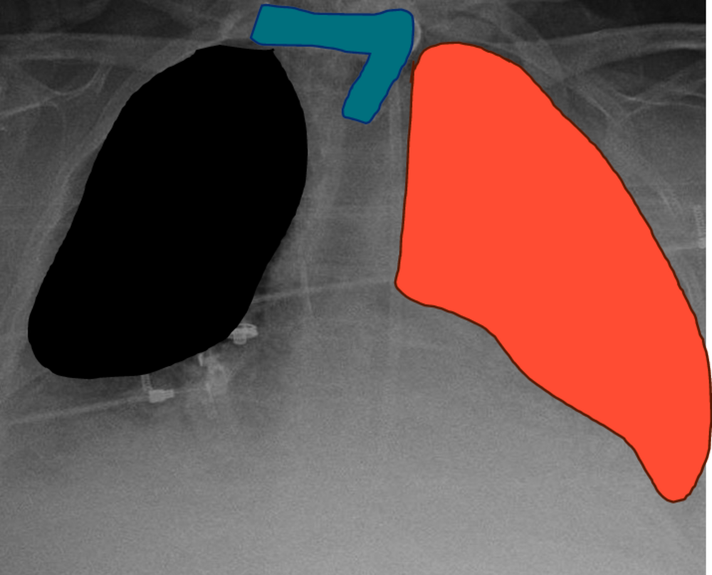 Radiographie thoracique avec zones colorées superposées, correction d'une question