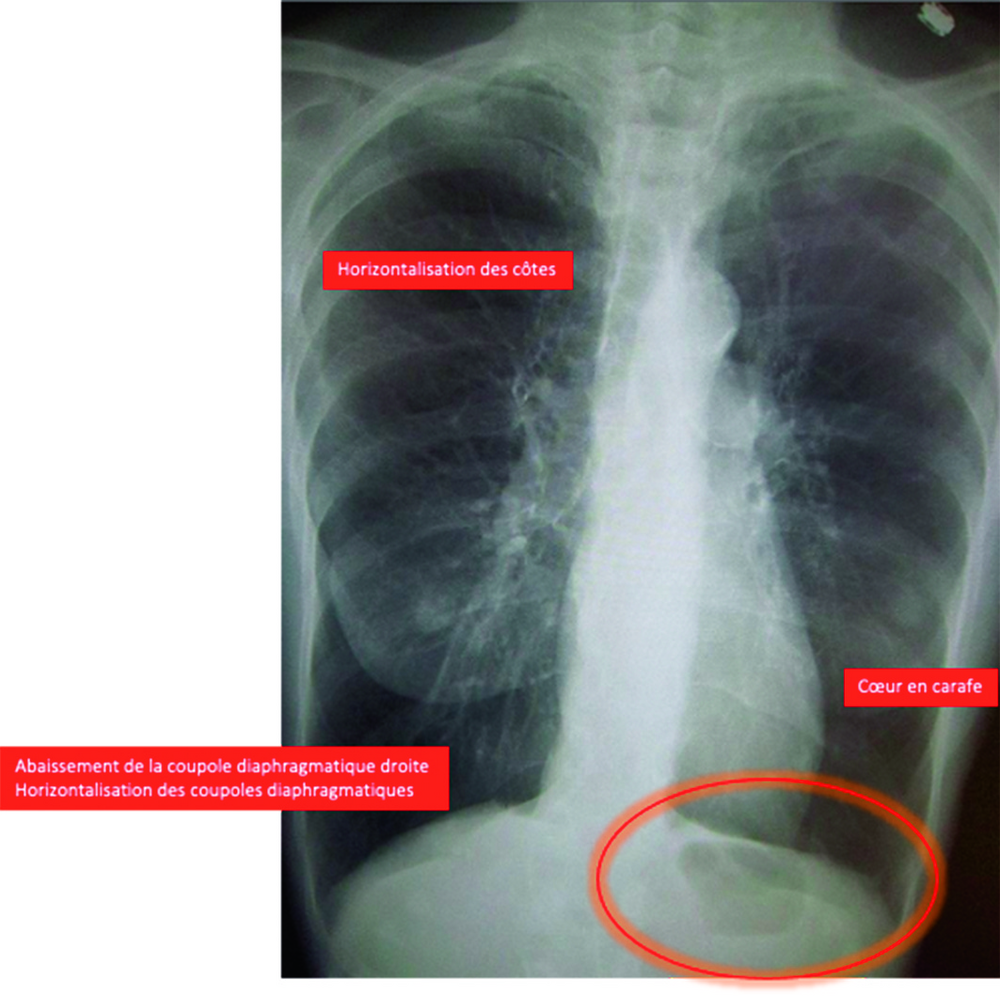 Radiographie thoracique de face annotée de légendes rouges et d'une zone cerclée, correction de question