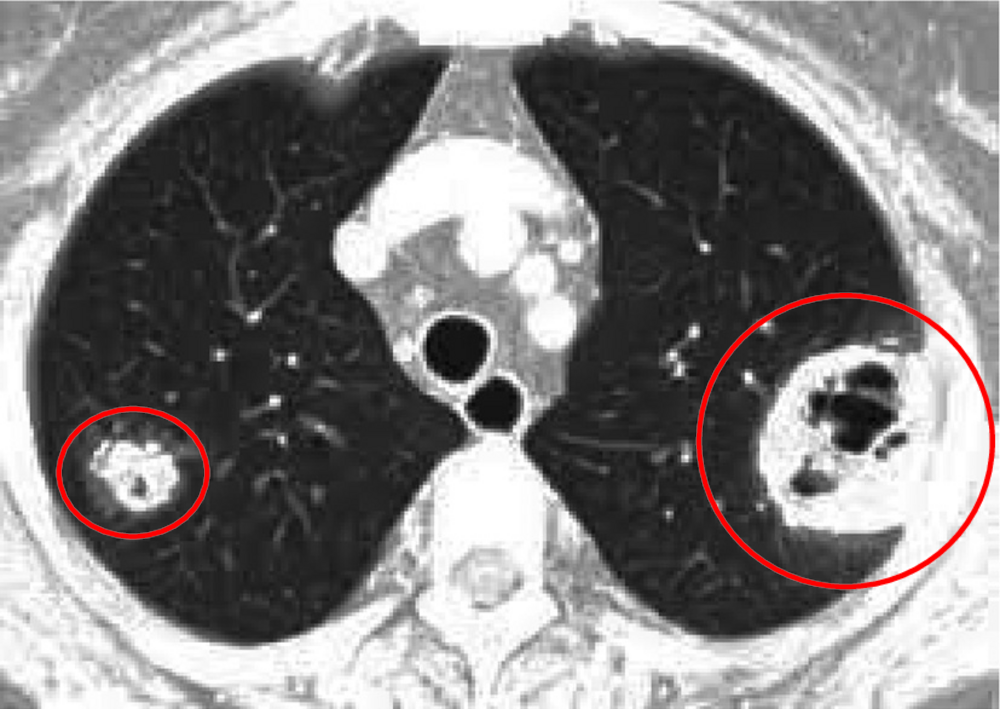 Coupe de scanner thoracique en fenêtre parenchymateuse avec deux zones entourées en rouge (corrigé)
