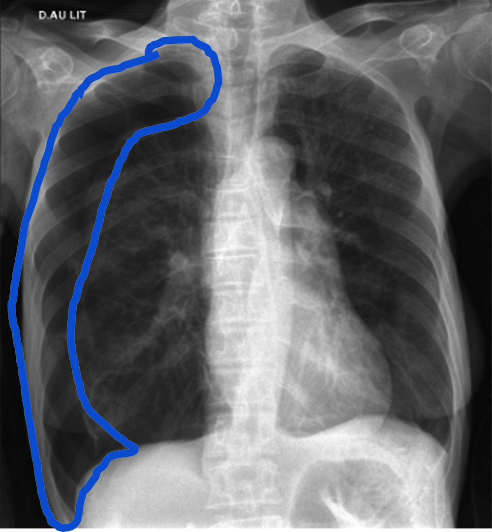 Radiographie thoracique de face avec une zone entourée en bleu, correction d'une question