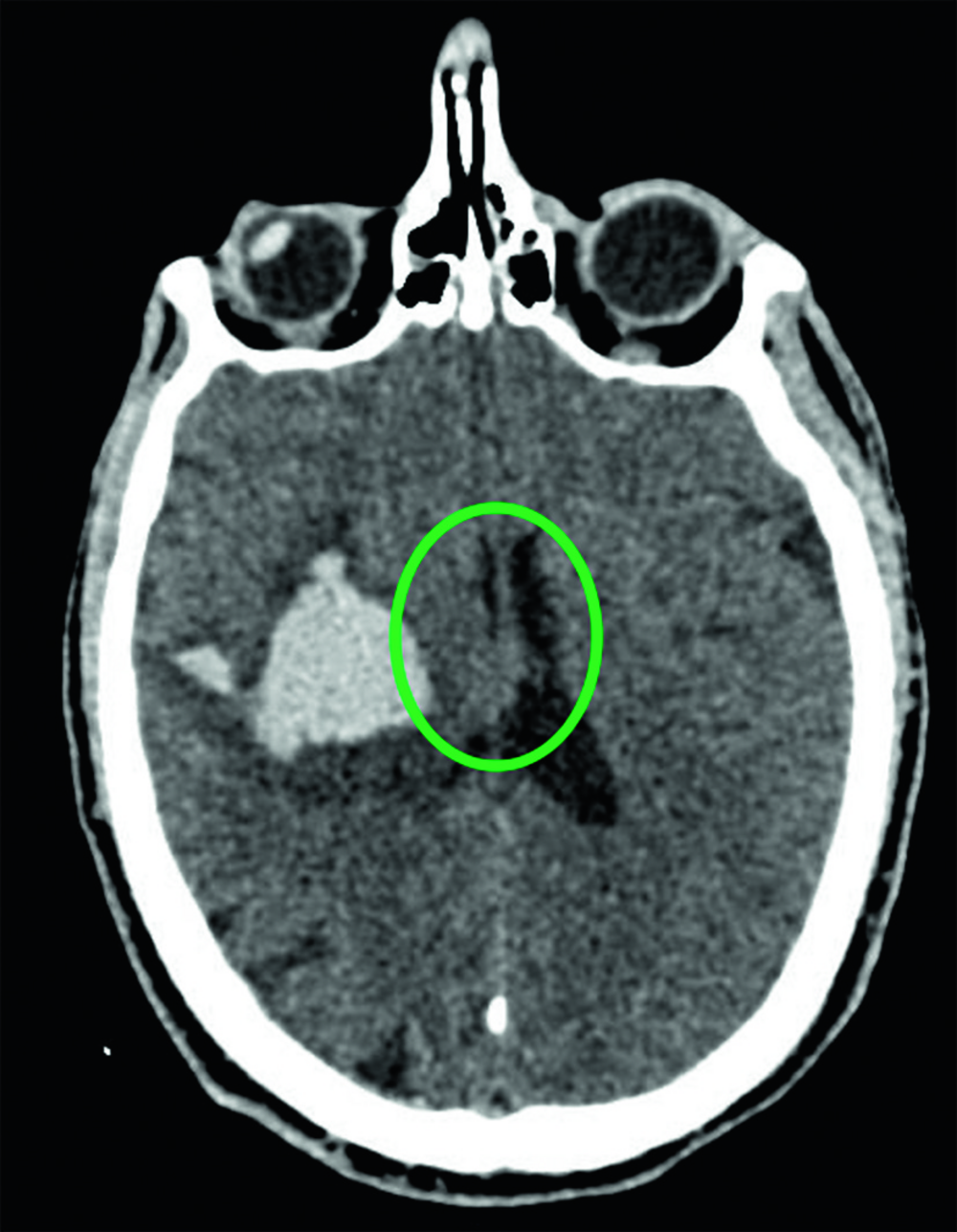 Coupe de scanner cérébral avec une zone cerclée en vert, illustrant le commentaire de correction