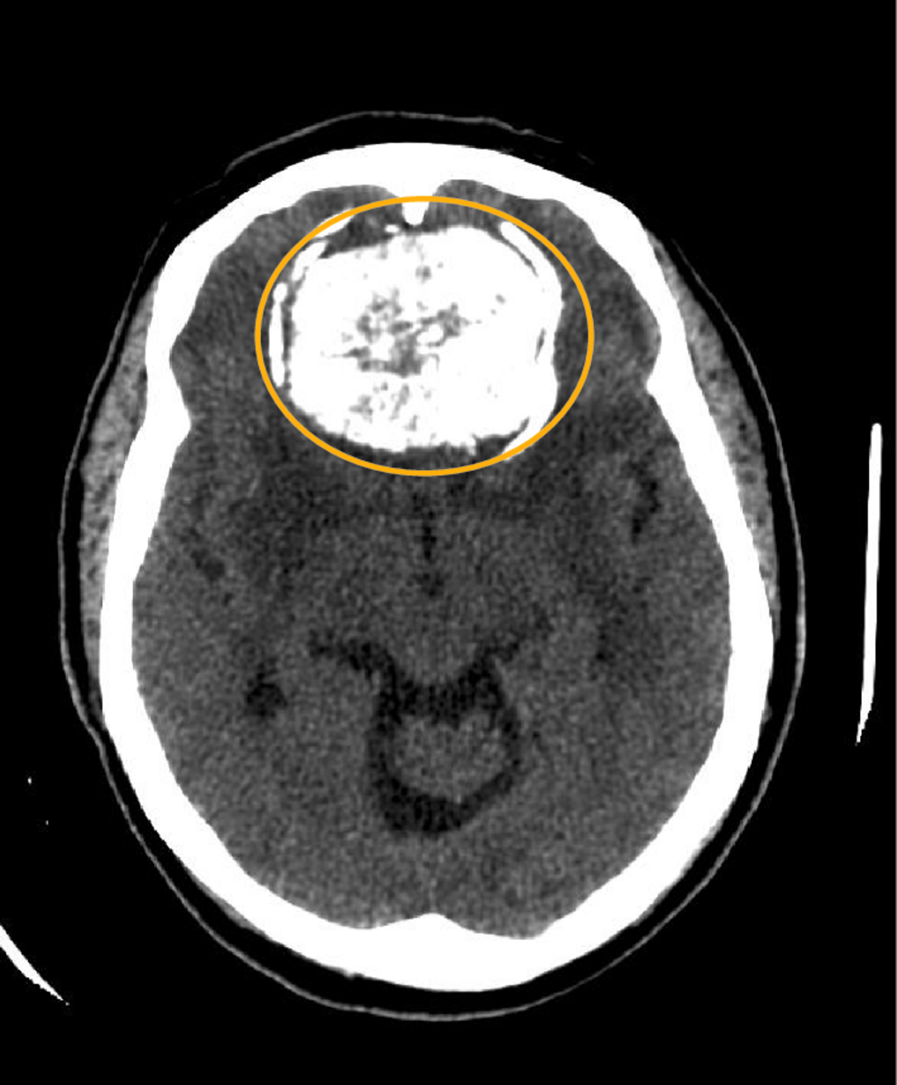 Coupe de scanner cérébral sans injection avec une zone cerclée en orange, correction d'une question de repérage