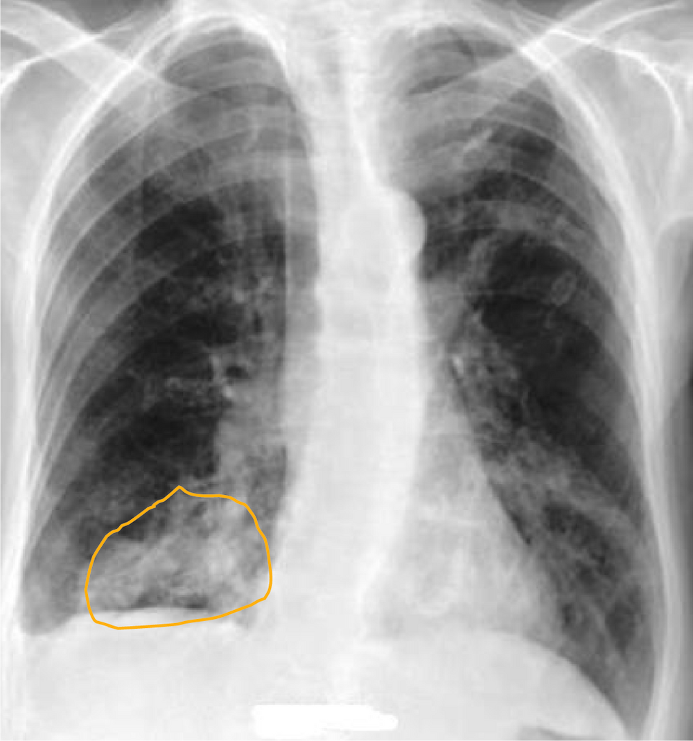 Radiographie thoracique de face avec une zone cerclée en orange, correction d'une question de repérage