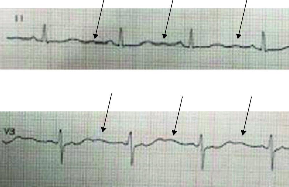 Deux tracés ECG des dérivations DII et V3 annotés de flèches (corrigé)