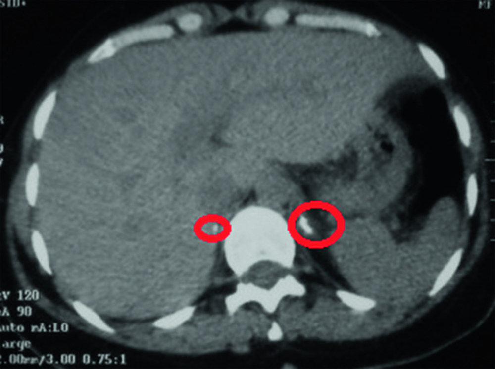 Coupe de scanner abdominal axiale avec deux zones entourées en rouge, correction d'une question