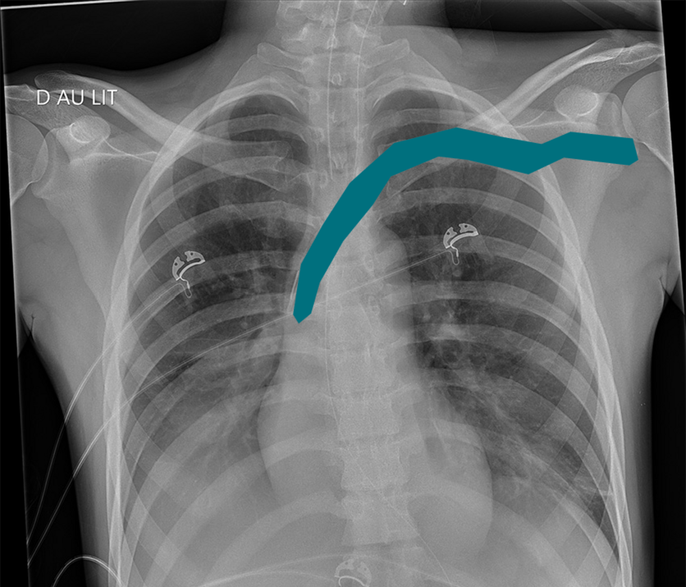 Radiographie thoracique de face au lit avec un tracé bleu superposé, illustrant le commentaire de correction