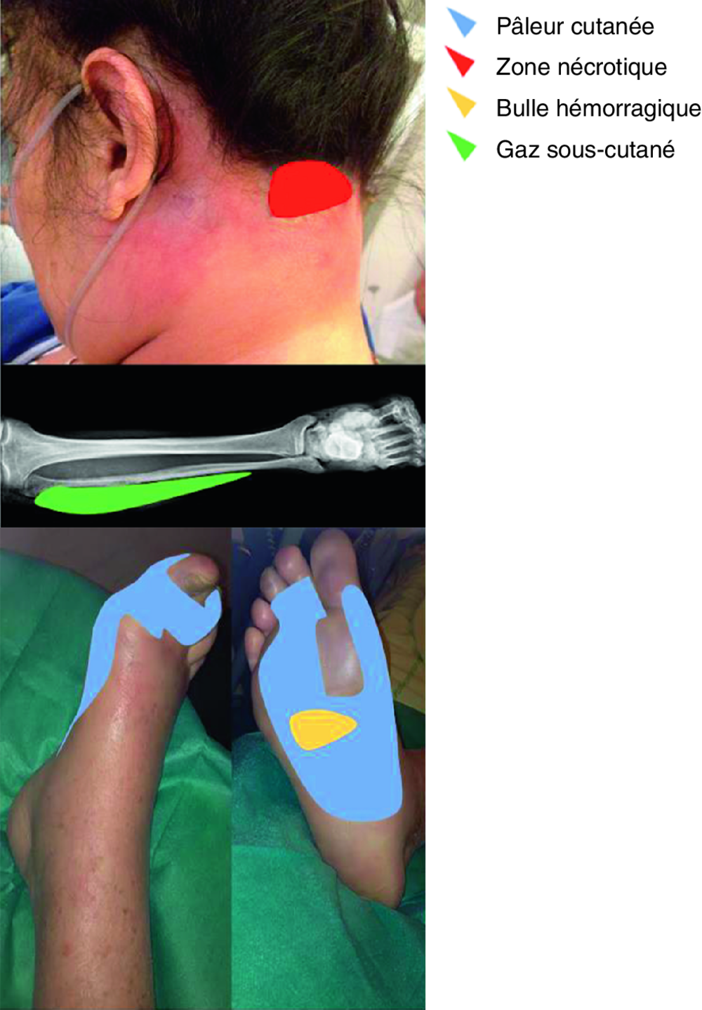 Photographies de la nuque, d'une radiographie de jambe et des pieds avec zones colorées et légende (corrigé)