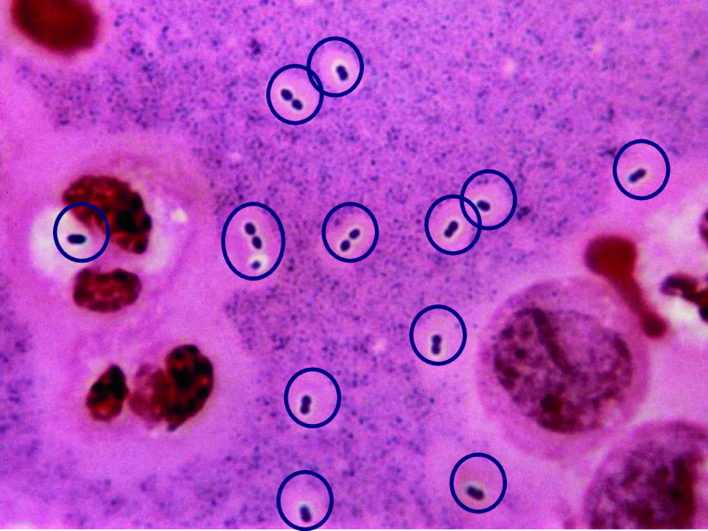 Examen direct du liquide cérébrospinal en coloration de Gram avec éléments entourés, correction d'une question