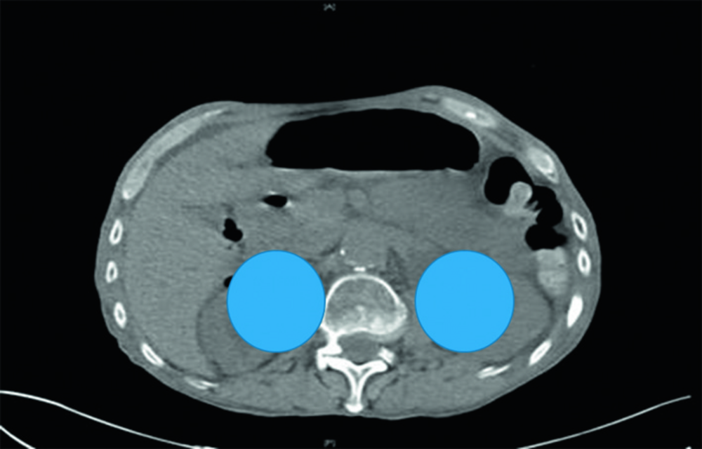 Coupe de scanner abdominal avec deux disques bleus superposés, correction d'une question de repérage