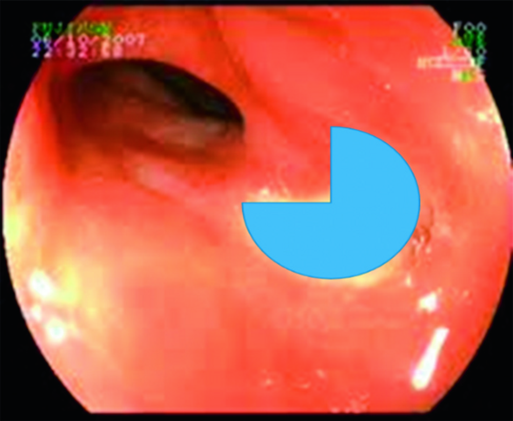 Image d'endoscopie digestive avec une zone colorée en bleu (corrigé)