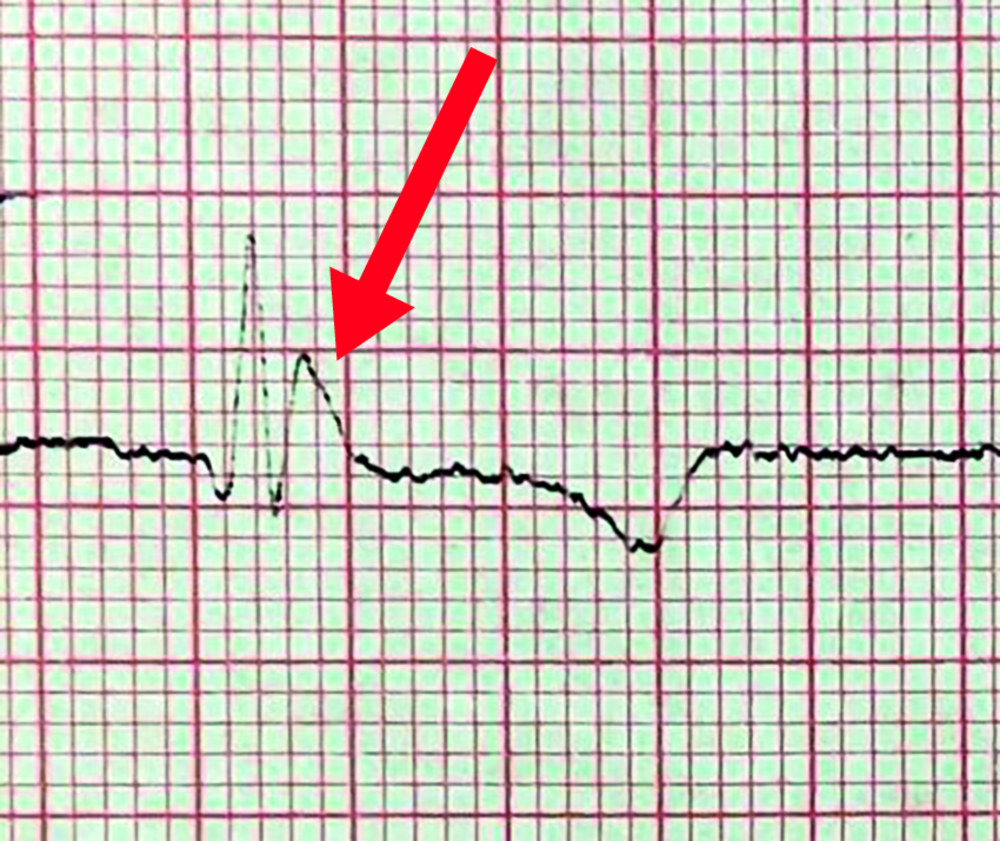 Tracé ECG sur papier millimétré avec une flèche rouge désignant une partie du tracé (corrigé)