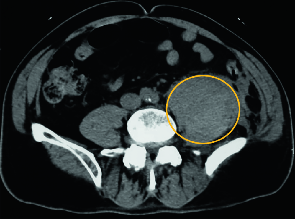 Coupe de scanner abdominopelvien axial sans injection avec une zone entourée en orange (corrigé)